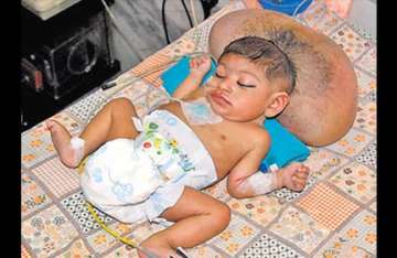 ahmedabad docs cut baby s 2nd head