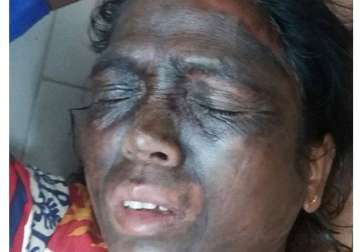 acid like substance rubbed on tribal activist soni sori s face in chhattisgarh