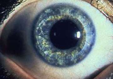 eye care institute performs 20 000 corneal transplants