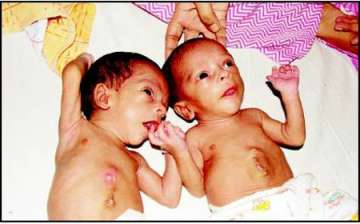 aiims docs separate conjoined twins