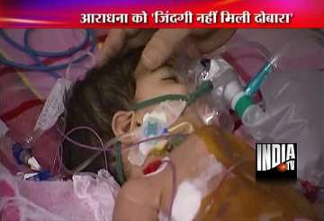one of separated siamese twins aradhana dies