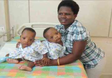 tanzanian conjoined twins separated at chennai hospital