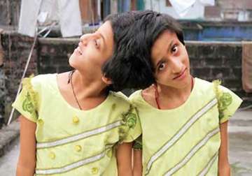 sc asks medical team to visit patna to examine conjoined twins