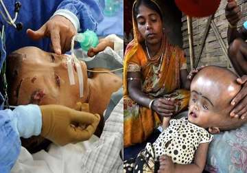 tripura girl with giant head syndrome roona gets new lease of life