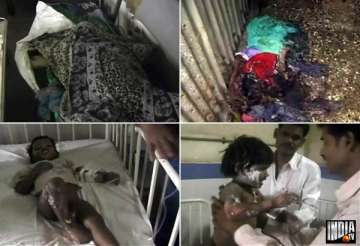 woman 2 kids suffer burns in bhiwandi short circuit fire