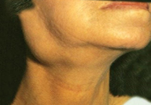 enlarged lymph node on back of neck