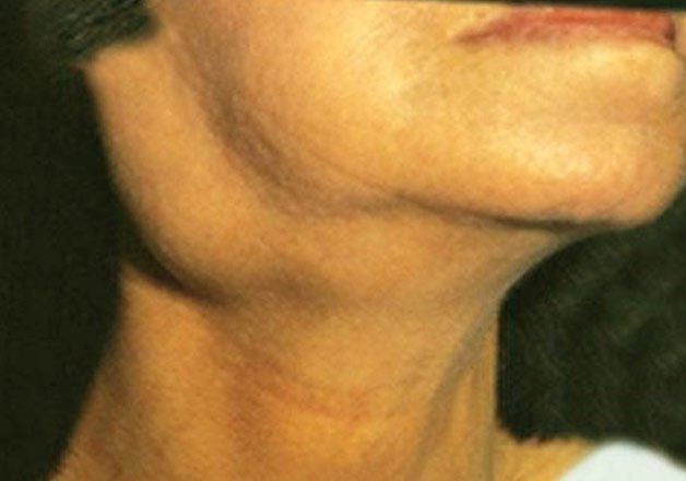 cancer swollen lymph nodes