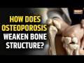 World Osteoporosis Day 2024: How does Osteoporosis weaken bone structure?