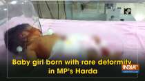 Baby girl born with rare deformity in MP
