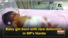 Baby girl born with rare deformity in MP's Harda